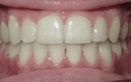 Fishbein Patient Ali Teeth After Treatment