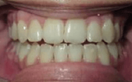 Fishbein Patient Cheyenne Teeth After Treatment
