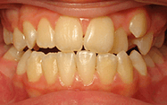Fishbein Patient Cheyenna Teeth Before Treatment