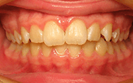 Fishbein Patient Meghan Teeth Before Treatment