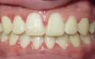 Fishbein Patient Ron Teeth After Treatment