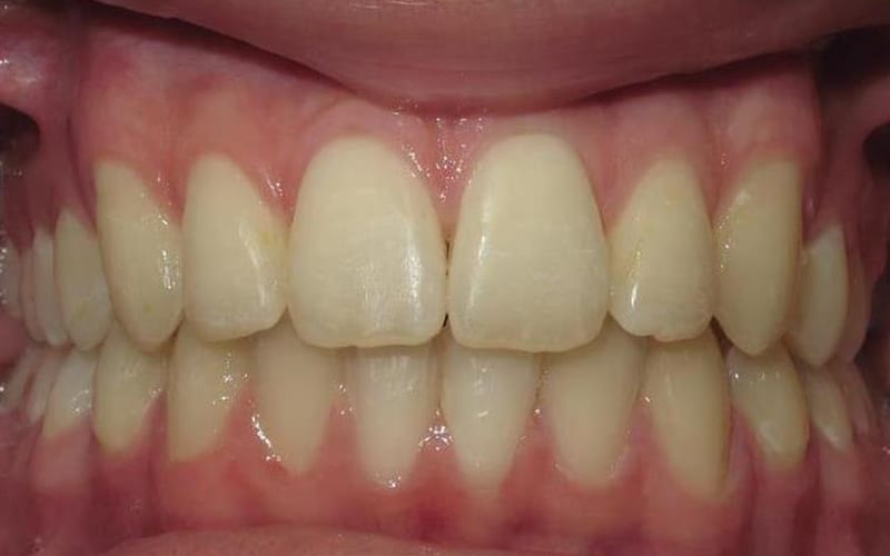 Fishbein Patient Demetre Teeth After Treatment