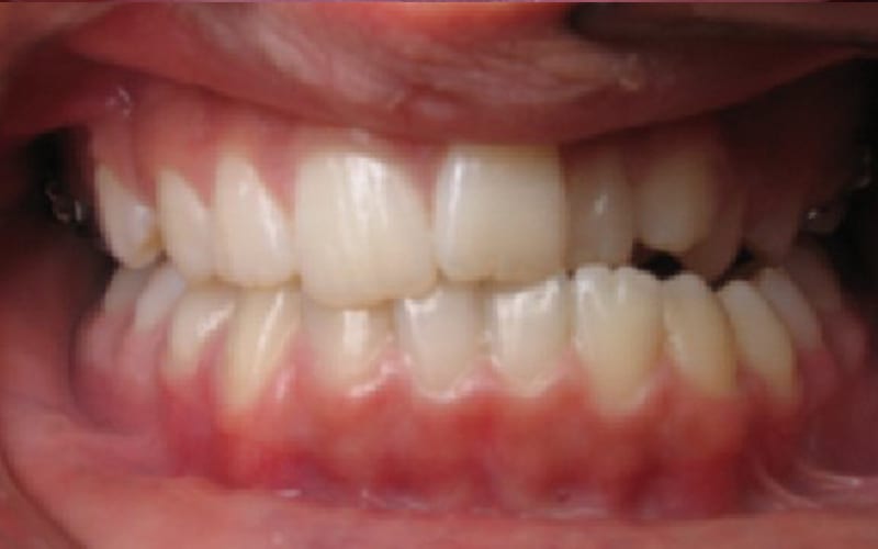 Fishbein Patient Demetre Teeth Before Treatment
