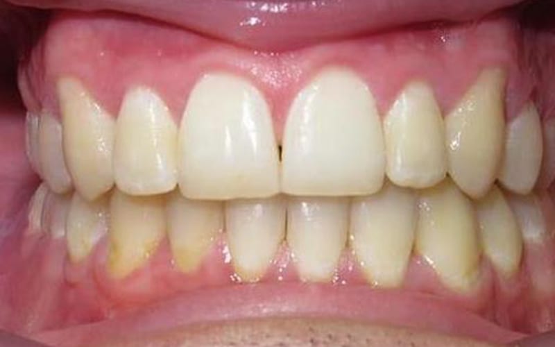 Fishbein Patient Ronald Teeth After Treatment